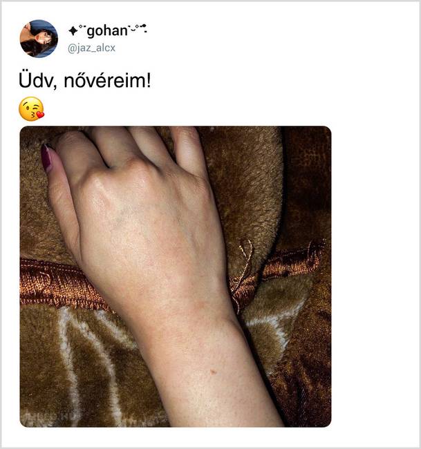 Egy véletlen Tweetből kiderült, hogy a világon majdnem minden nőnek pontosan ugyanolyan anyajegye van