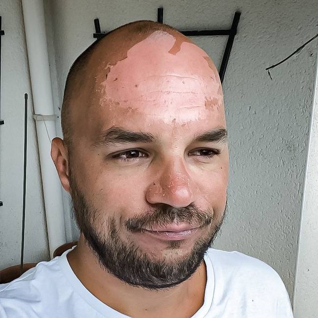 „A nyaralás után rájöttem, hogy nyilván nem raktam elég naptejet a homlokomra."