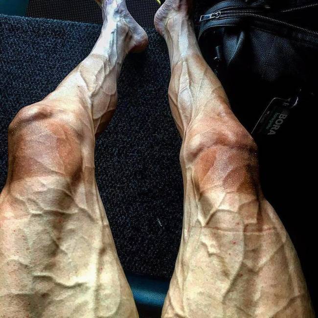 A lengyel kerékpáros, Paweł Poljański leégett és erektől duzzadó lábai egy Tour de France verseny után.