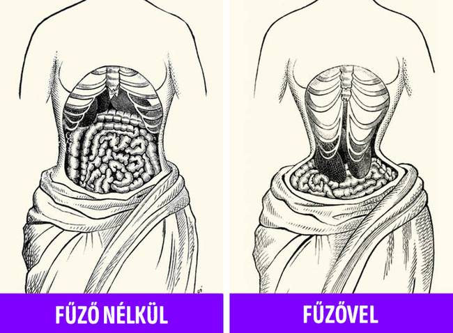A fűzők annyira szorosak voltak, hogy megváltoztatták a nők anatómiáját.