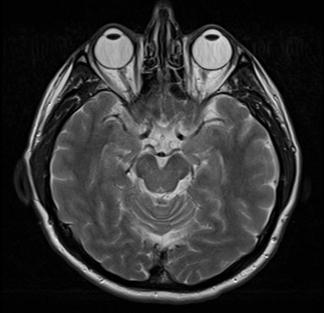 MRI felvétel egy ép és egészséges emberi agyról.