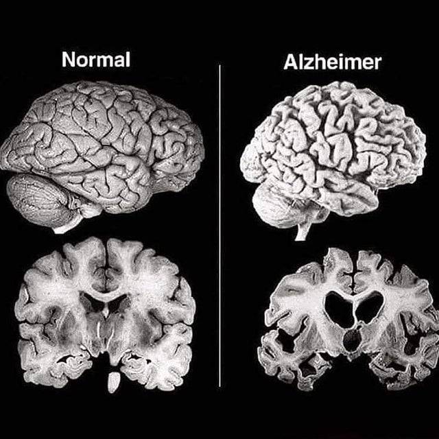 Ez a fotó jól mutatja, hogy mit csinál az agyunkkal az Alzheimer-kór.