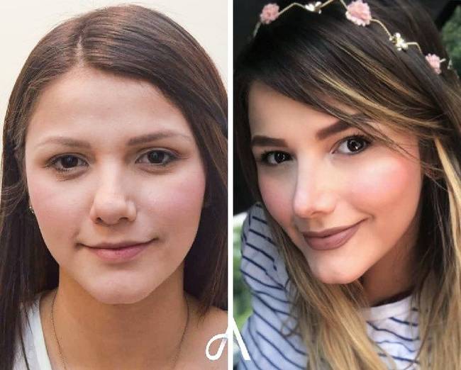 20 nő, aki megcsináltatta az orrát, és most nem hiszed el, hogy ugyanaz a személy van a fotón