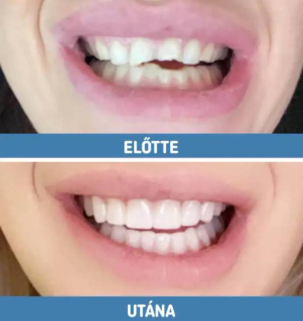 Előtte utána fotók 013