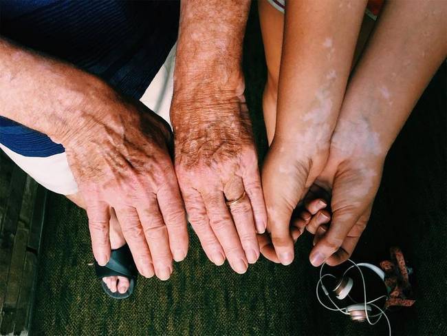 A vitiligo rendellenesség miatt a nagyapa és unokája keze is pigmenthiányos.