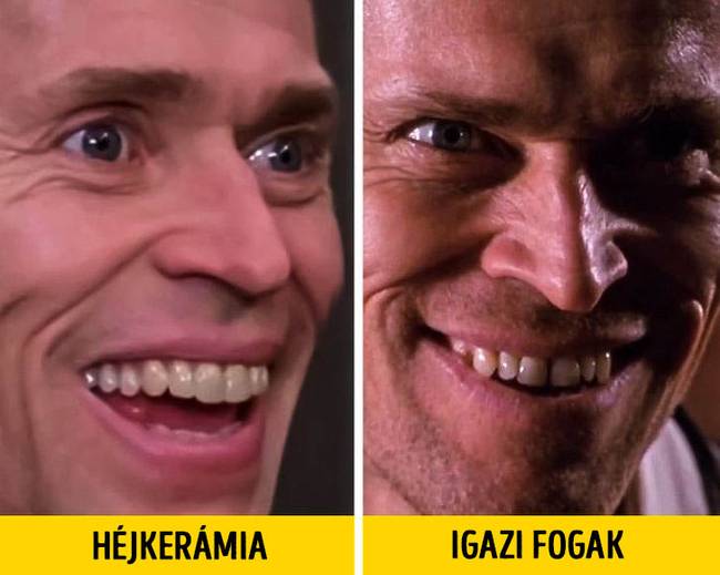 A Pókemberben Norman Osbornt alakító Willem Dafoe fogain héjkerámiák vannak.