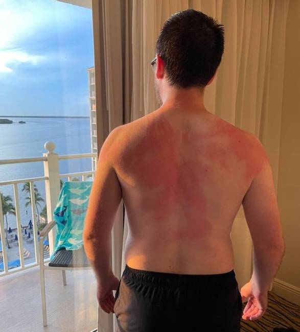 „A menyasszonyom így kente be naptejjel a hátamat."