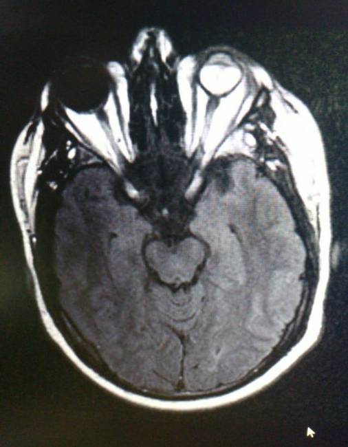„A férjem vak a bal szemére és az MRI-jén teljesen feketének tűnik ez a szeme."