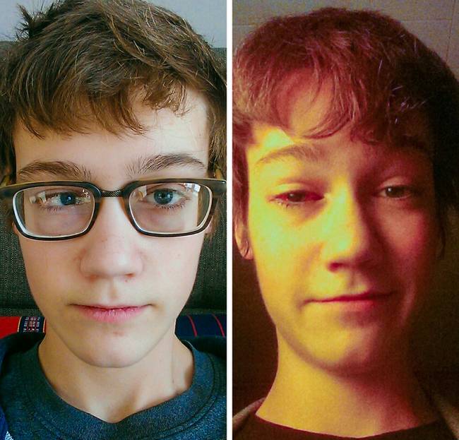 Strabismus (kancsalság) korrekció.