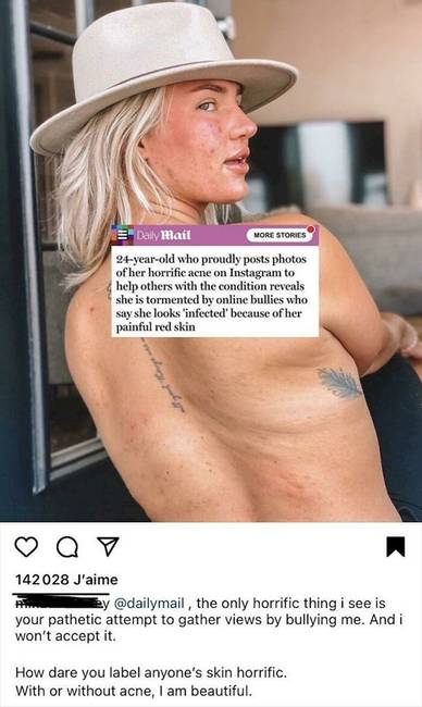 Ez az Instagram modell úgy döntött, hogy az egész világ előtt vállalja fel, hogy milyen is a bőre retusálás nélkül.