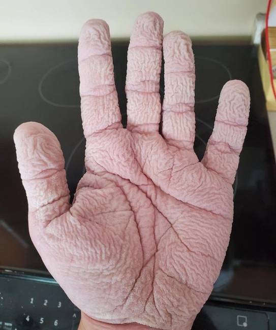 „A kezem 20 percnyi mosogatás után."