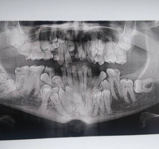 „Ritka betegségem van, az úgynevezett cleidocranial dysostosis. Ma kaptam meg az első fogászati röntgenfelvételemet, amiről kiderült, hogy sokkal több fogam van, mint kellene."