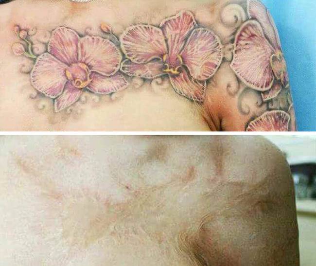 20 fantasztikus tetoválás, ami műalkotássá varázsolta az anyajegyeket és hegeket