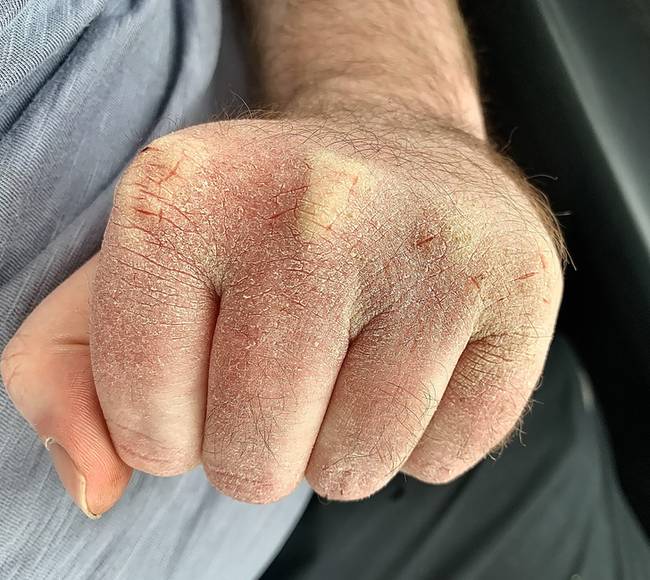 „Ezek a következményei annak, hogy egy laboratóriumban dolgozom, -10 °C-os hőmérsékleten, ahol napi 40-szer kell kezet mosnom."