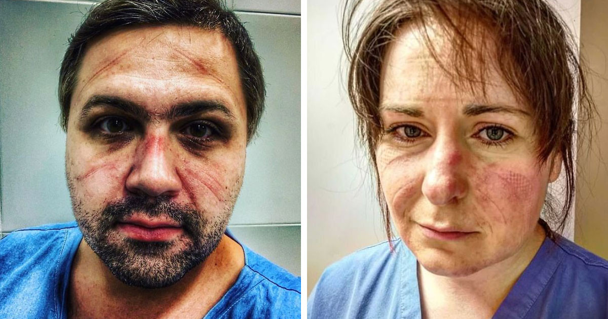 18 fotó, ami megmutatja, hogyan néz ki a kórházi dolgozók arca egy fárasztó műszak után