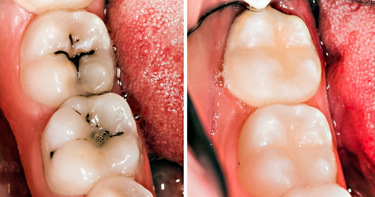8 elképesztően egyszerű dolog, amivel megelőzheted a fogszuvasodást