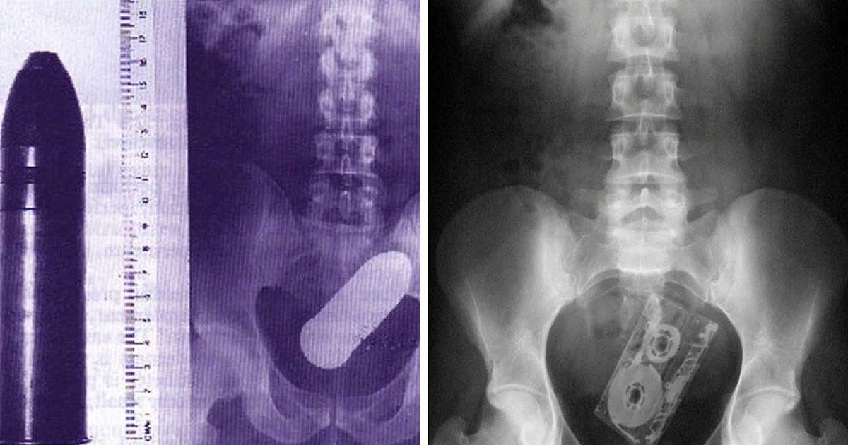 21 bizarr tárgy, amit az emberek fenekében találtak az orvosok