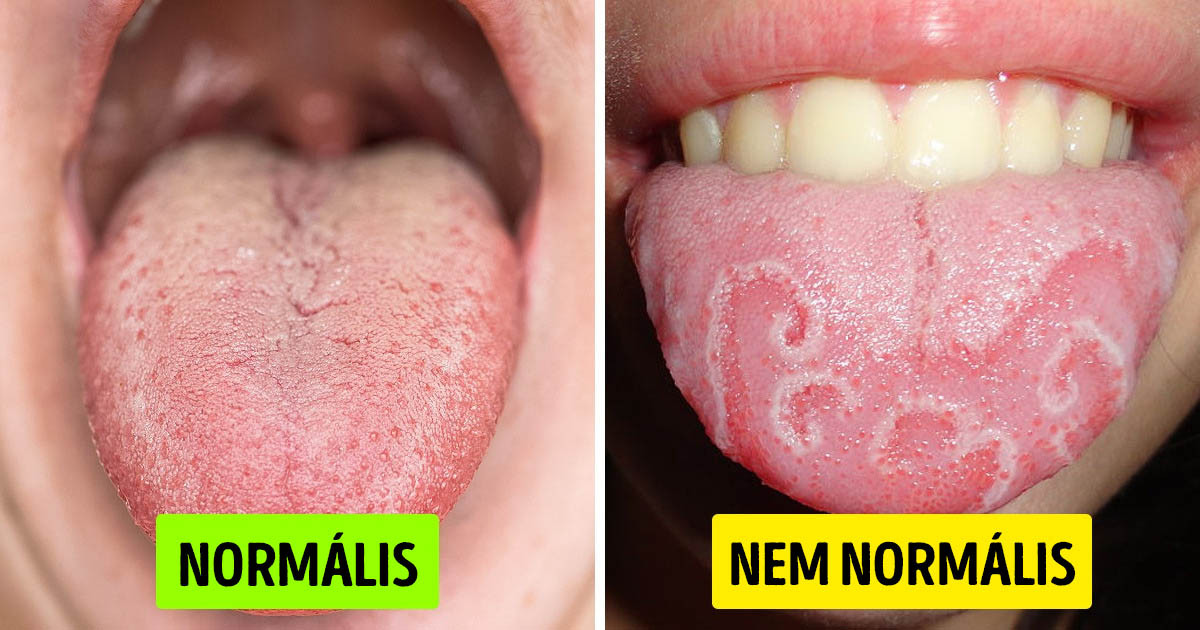 Mit jelent a lepedék a nyelven és hogyan lehet megszabadulni tőle