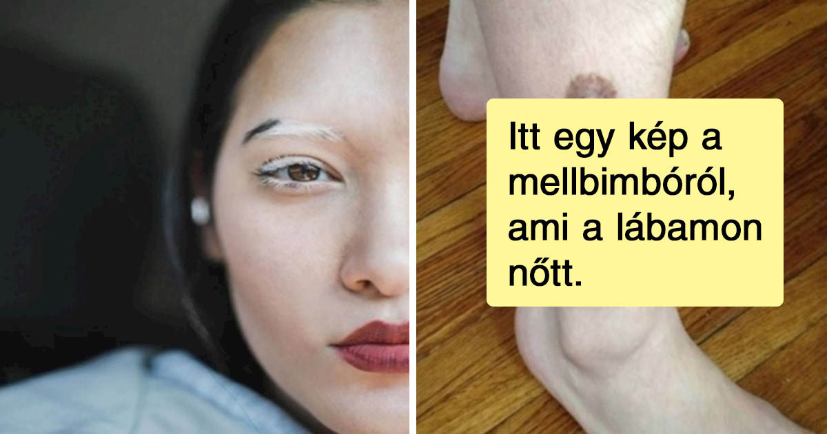 12 ember, akik a genetikai mutációjuk miatt váltak híressé