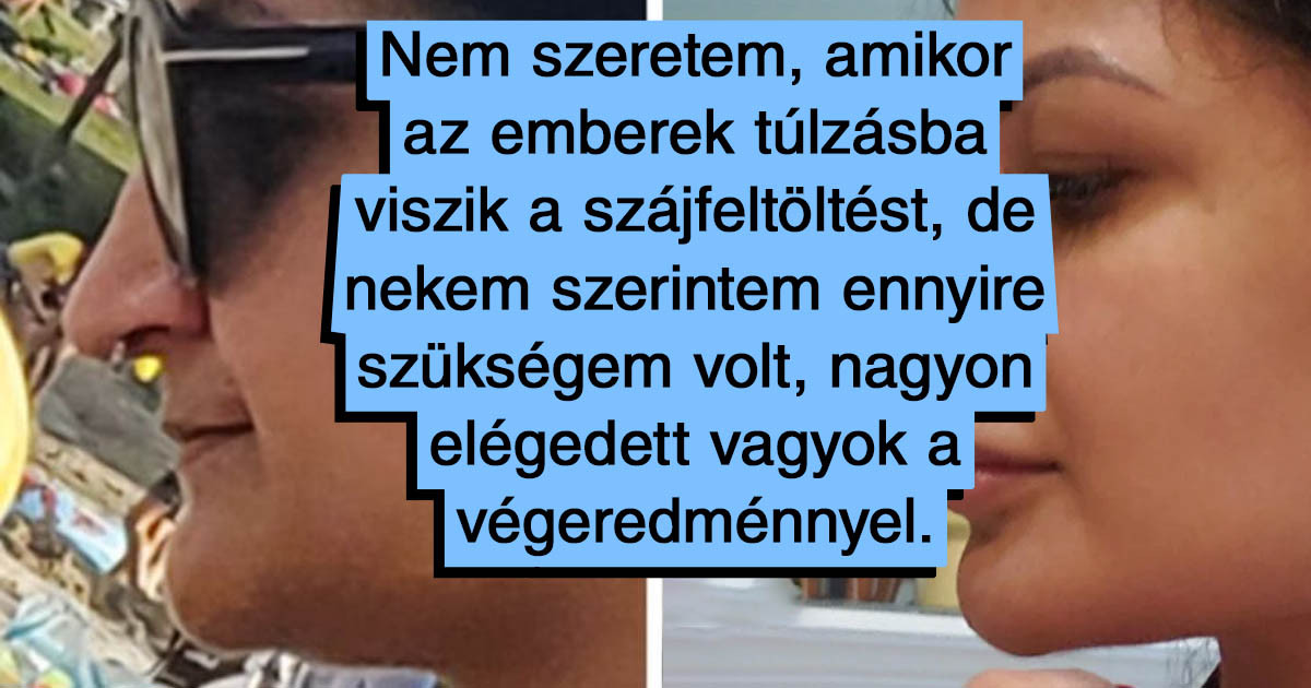 21 ember, akiknek olyan jól sikerült a plasztikai műtét, hogy most 3x gyakrabban néznek a tükörbe